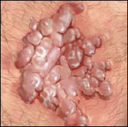 anal warts left untreated
